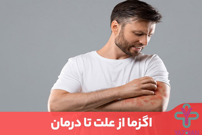 اگزما در کودکان و انواع آن